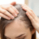 How Long Does PRP Take to Show Hair Growth Results