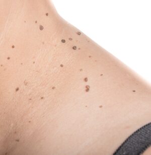 Can You Remove a Mole in One Session?