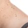 Can You Remove a Mole in One Session?
