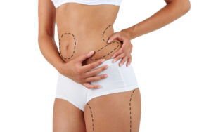 Liposuction in Islamabad