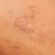 Regain Confidence with Spider Veins Treatment