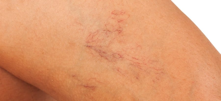 Regain Confidence with Spider Veins Treatment