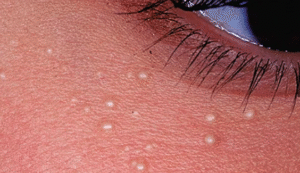 Skin Tag Removal in Dubai