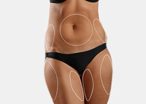 SculpSure for Belly, Thighs, and Arms