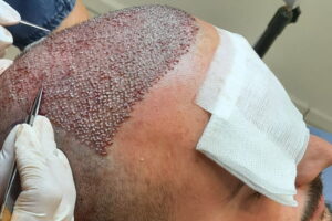 What Age Is Best for Hair Replacement Procedures?