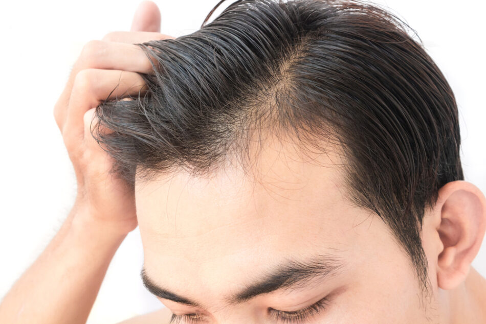 What Happens After 1 Dirham Hair Transplant Surgery?