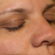 skin tag removal