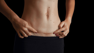 Abdominoplasty in Islamabad