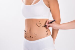 Abdominoplasty in Islamabad