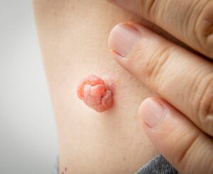 Can Skin Tags Bleed When They Are Removed
