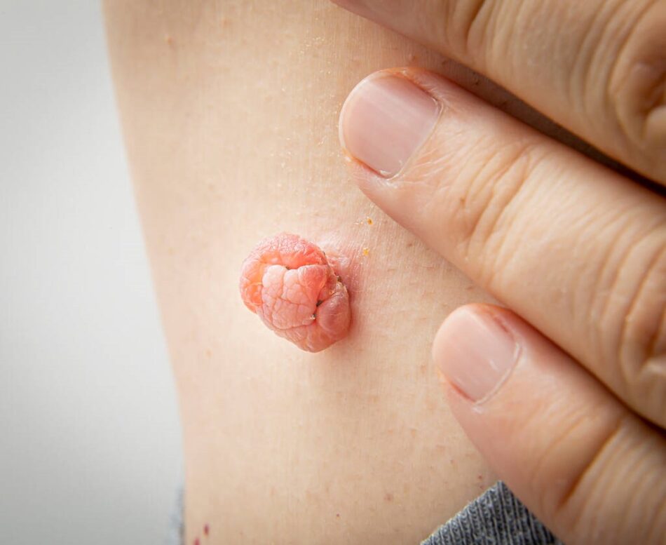 Can Skin Tags Bleed When They Are Removed
