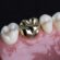 Dental Crown Bridges in Islamabad