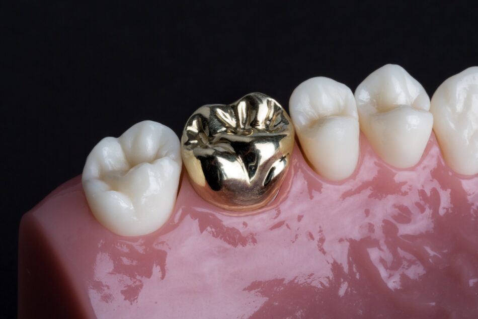 Dental Crown Bridges in Islamabad