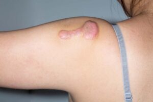 Does Keloid Treatment Stop Itching