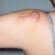 Does Keloid Treatment Stop Itching