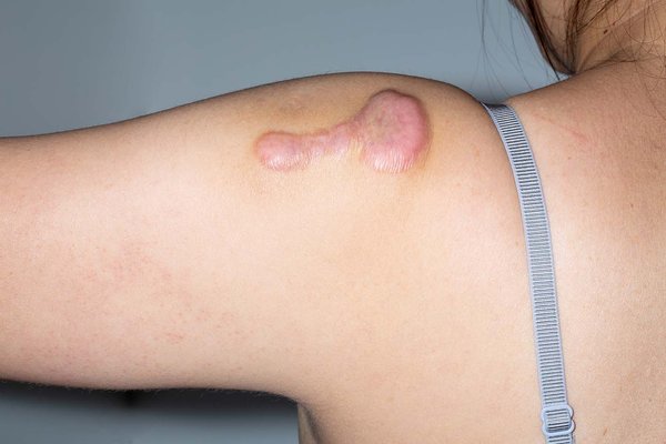 Does Keloid Treatment Stop Itching