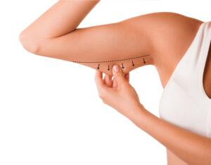Does Ultrasound Cavitation Work on the Arms