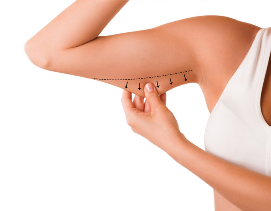 Does Ultrasound Cavitation Work on the Arms