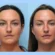 Thread Lift Treatment in Dubai: Transform Your Appearance and Restore Youthful Contours