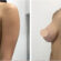breast lift in dubai