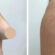 breast reduction in dubai