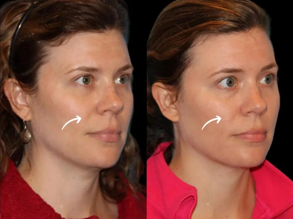 sculptra fillers in dubai