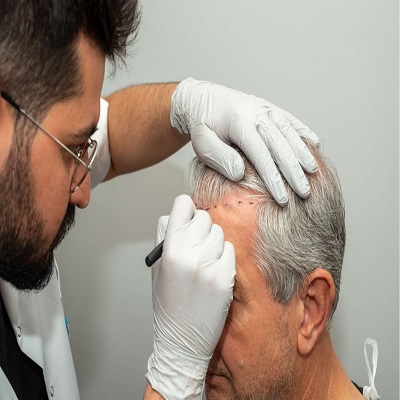 Hair Transplant in Islamabad
