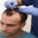 Hair Transplant surgery in Islamabad