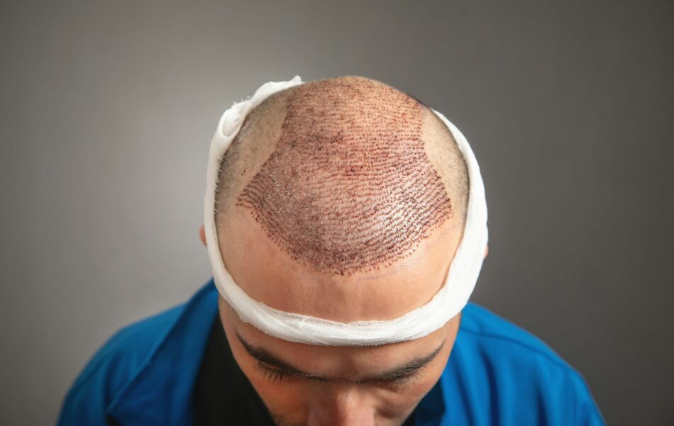 Hair transplant in Islamabad