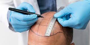 High Quality Hair Transplants at Reasonable Costs