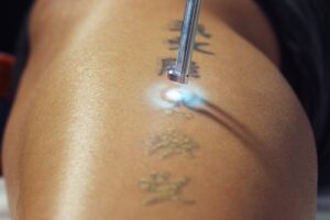 How Does Laser Tattoo Removal Work
