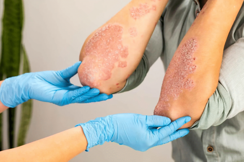 How Does the Best Dermatologist Treat Eczema