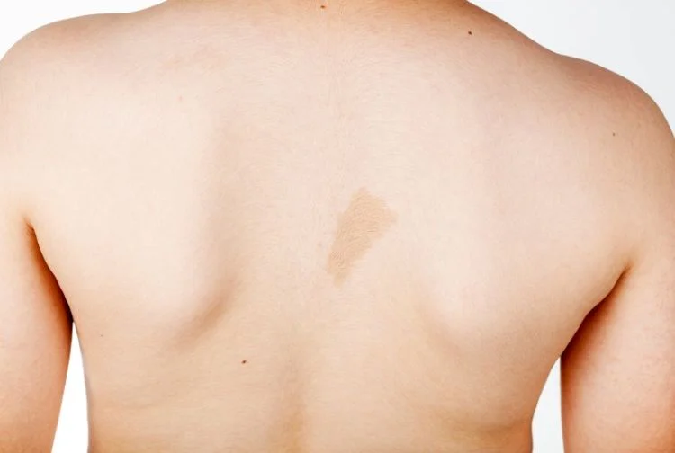 How Many Sessions Need for Birthmark Removal?