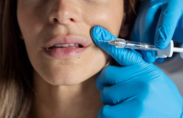 How Many Sessions for Lip Fillers