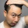 Is Scalp Micropigmentation Better Than Hair Transplant?