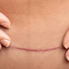 Is Surgical Scar Revision Right for My Type of Scar?