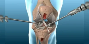 Best Knee Replacement Surgeon in Jaipur