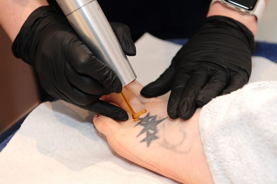 Laser Tattoo Removal Tailored to You