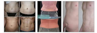 Liposuction FAT REMOVAL TREATMENT