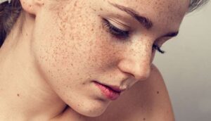 Melasma Treatment in Islamabad