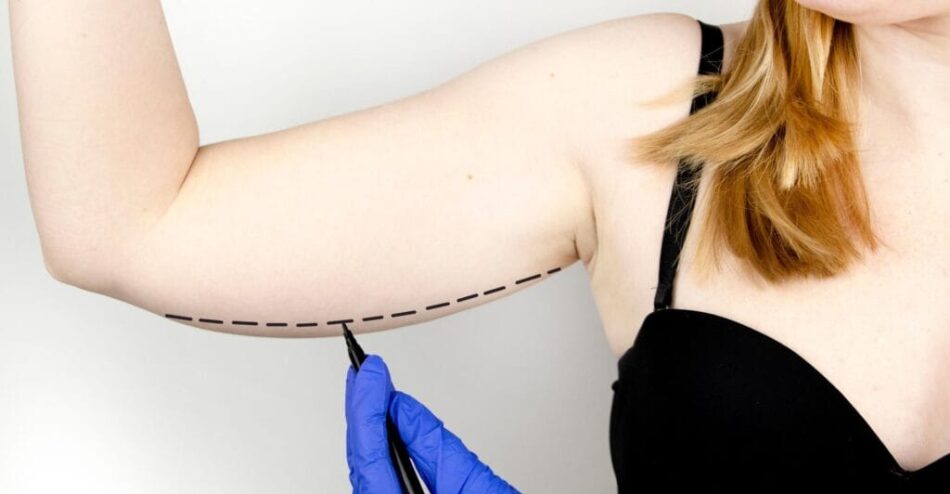Non-Surgical and Surgical Arm Lift Options