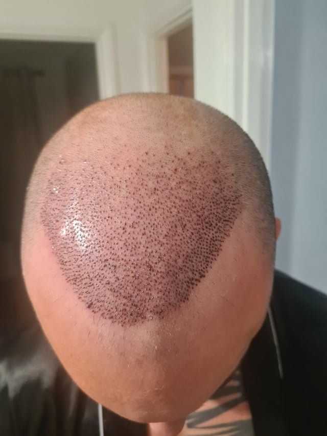 The Ultimate Guide to Crown Hair Transplants