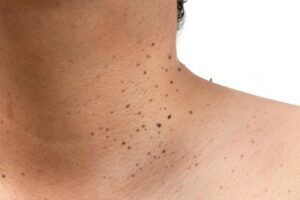 Can Skin Tag Removal Cause Scarring?
