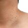 Can Skin Tag Removal Cause Scarring?