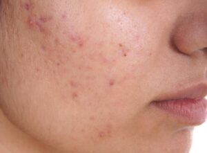 What’s the Best Time to Start Acne Treatment