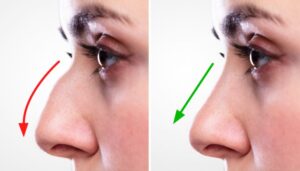 best rhinoplasty in islamabad