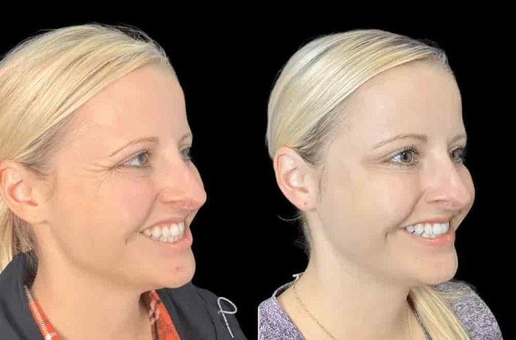 Frown Lines Fade at the Best Aesthetic Clinic in Dubai for Botox