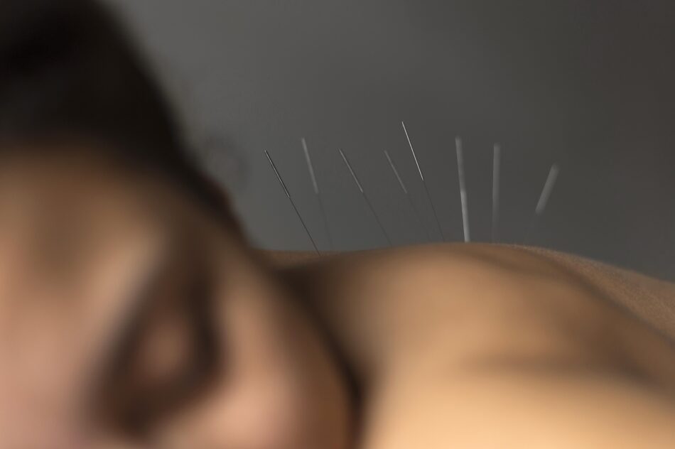 infertility treatment acupuncture