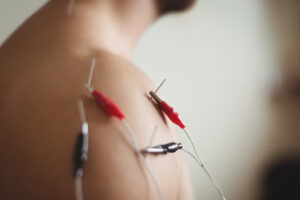 Acupuncture After Car Accident: