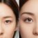 doubled eyelid surgery